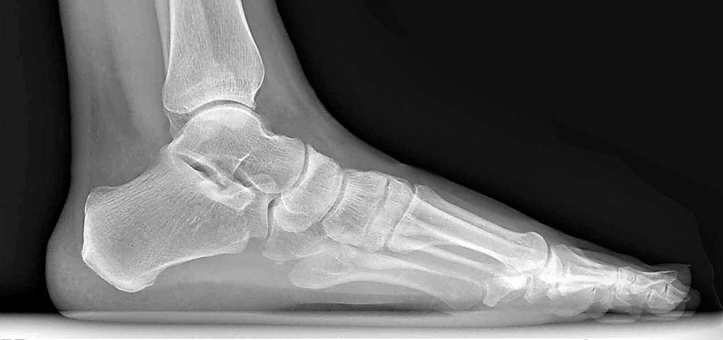 Background x-ray image of a foot